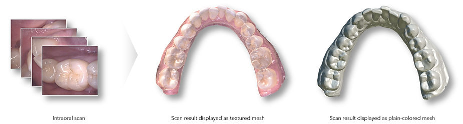 Intraorales 3D-Scanning (infini scan)
