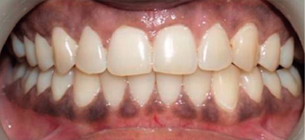 Intraoralscan eines Patientengebisses