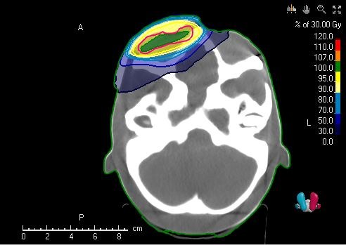 Planungs-CT mit Isodosenlinien über dem behandelten Areal