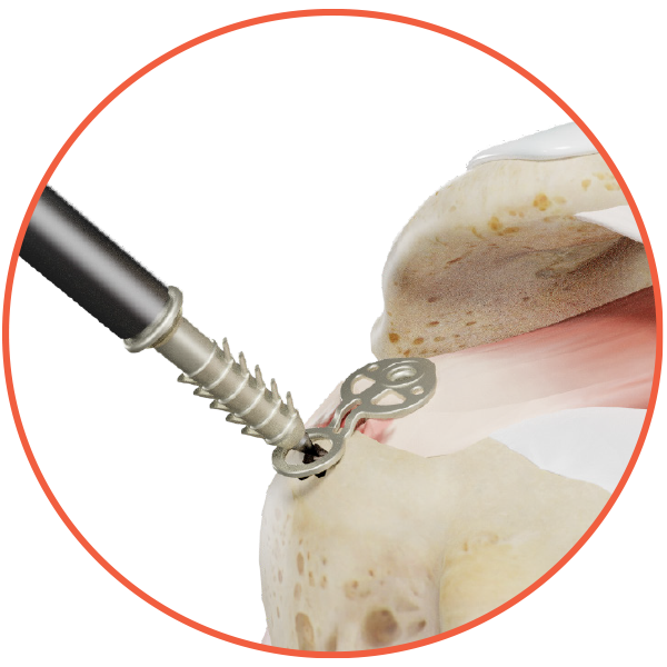 Rotator Cuff Repair
