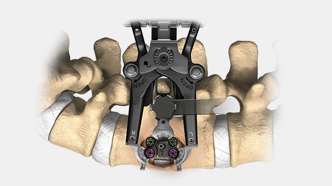 Expandabler Interbody-Spacer (XLIF-Retraktorsystem)