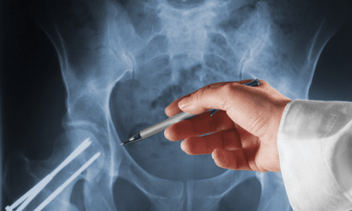 Knochenschraube (Implantat)