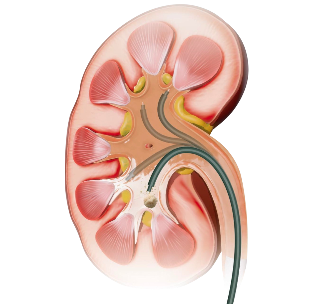 Flexible ureterale Zugangsschleuse