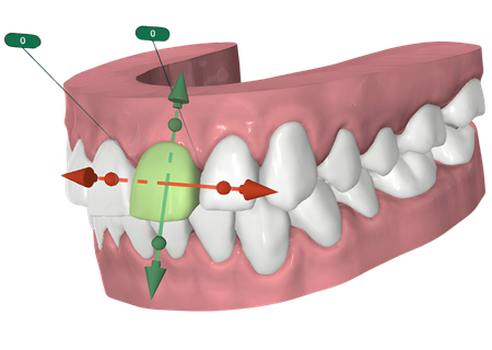 Clear Aligner (Tray)