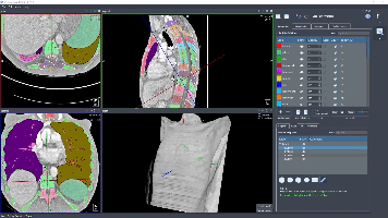 Automatisierte Segmentierung anatomischer Strukturen (Wirbelsäule/Thorax)