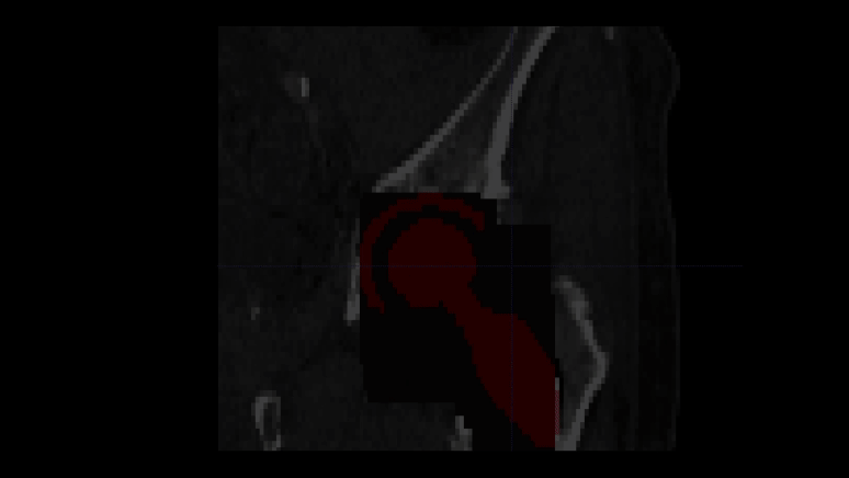 KI-gestützte Implantatplanung (Hüfte/Knie)