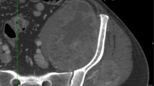 Weg zur automatischen Hüft- und Femur-Segmentierung aus CT