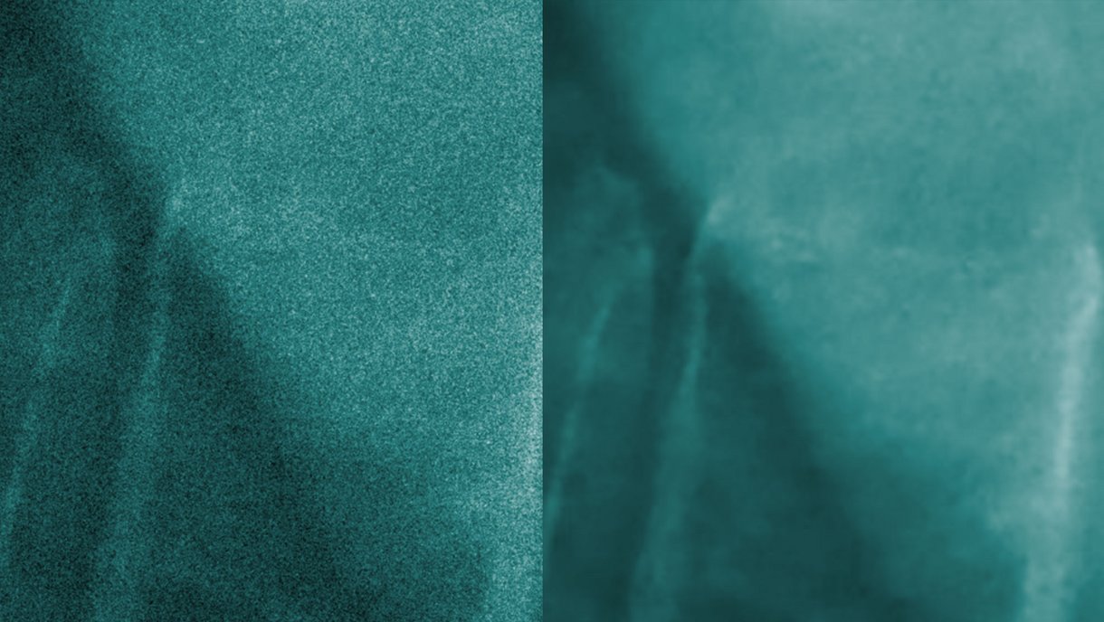 KI-basiertes Denoising von CT-Bildern