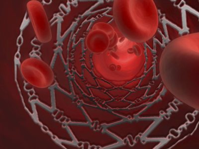 Medizintechnik-Anwendung (Stent)