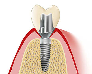 Implantatkrone aus VITA ENAMIC