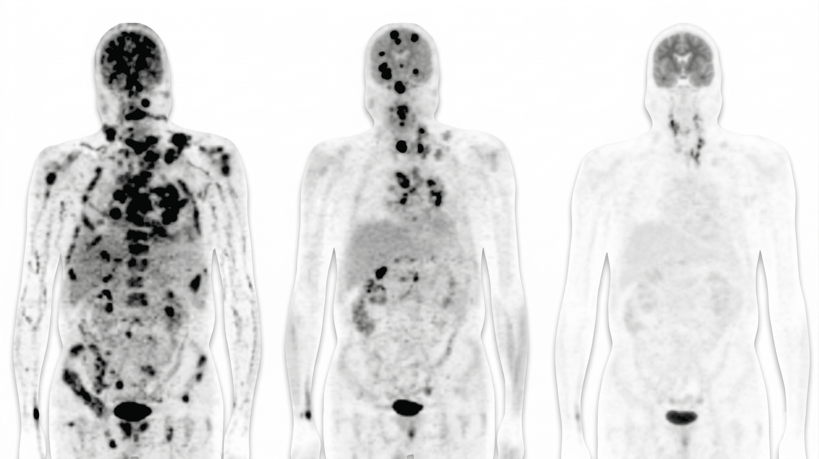 PET-Aufnahme – bildgebende Diagnostik in der Onkologie