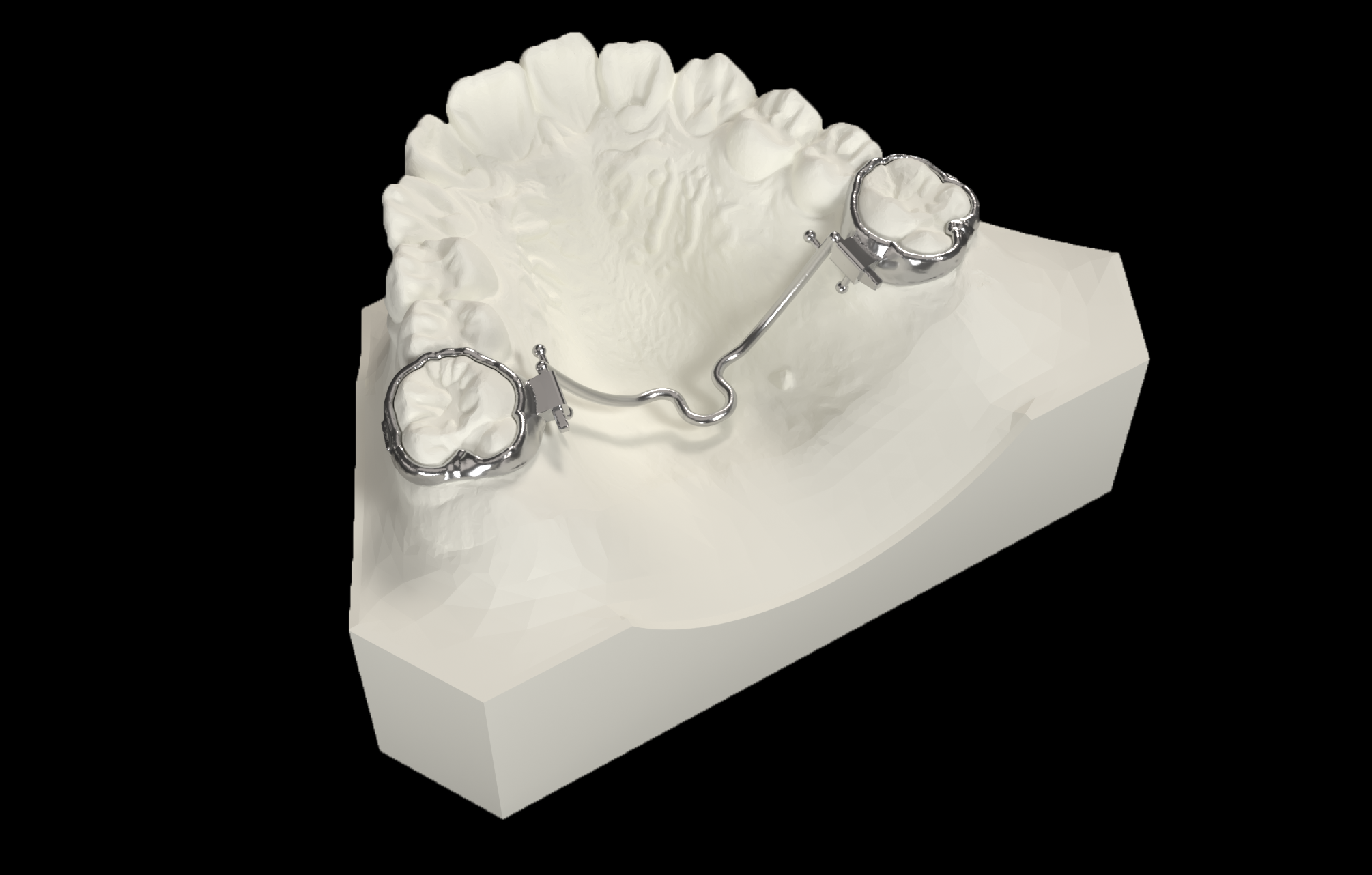 Palatal-Fit3R Remove V2 (Active)