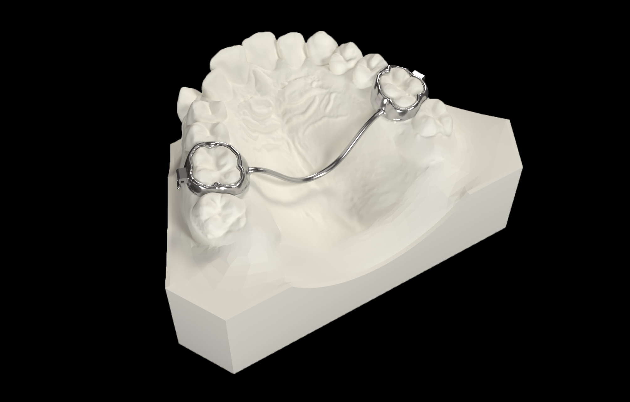 Palatal-Fit3R Fix V1 (Passive)