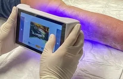 Digitale Wunddokumentation und BakterienScan in der Anwendung