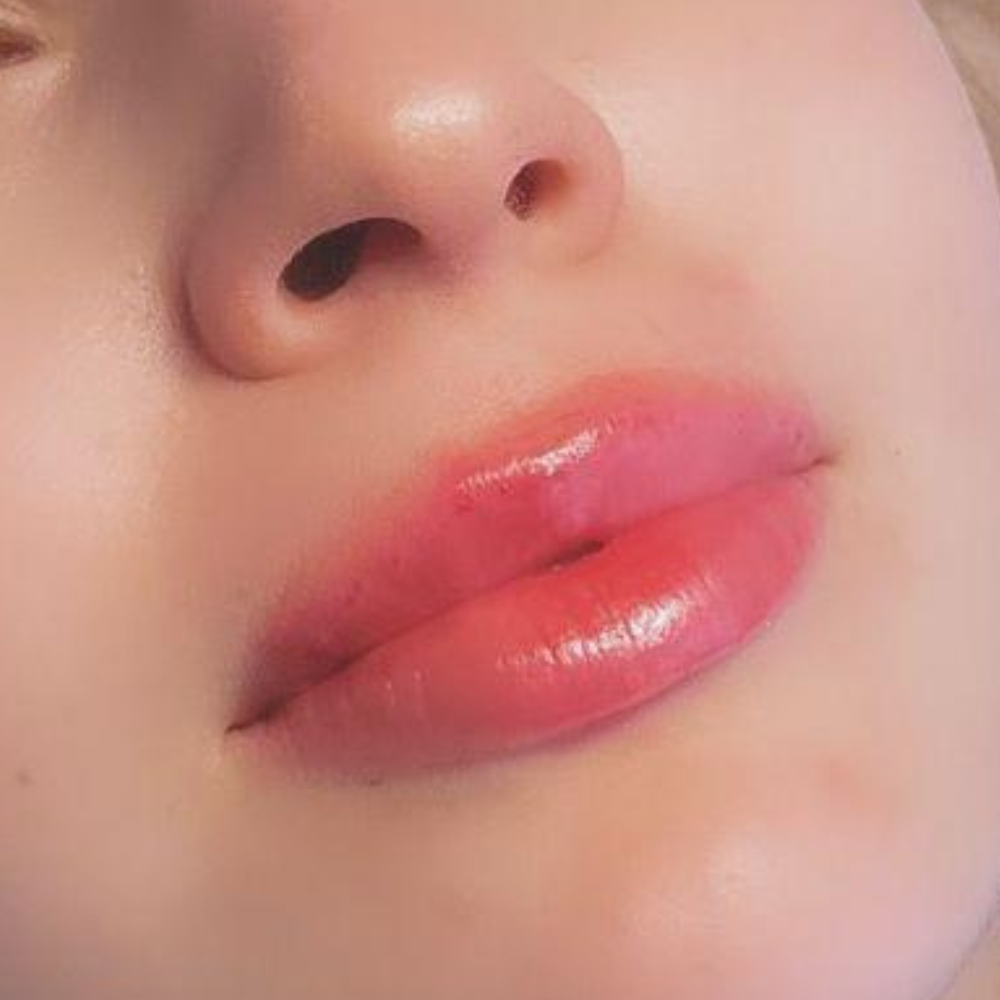Definierte Lippenkontur nach Behandlung