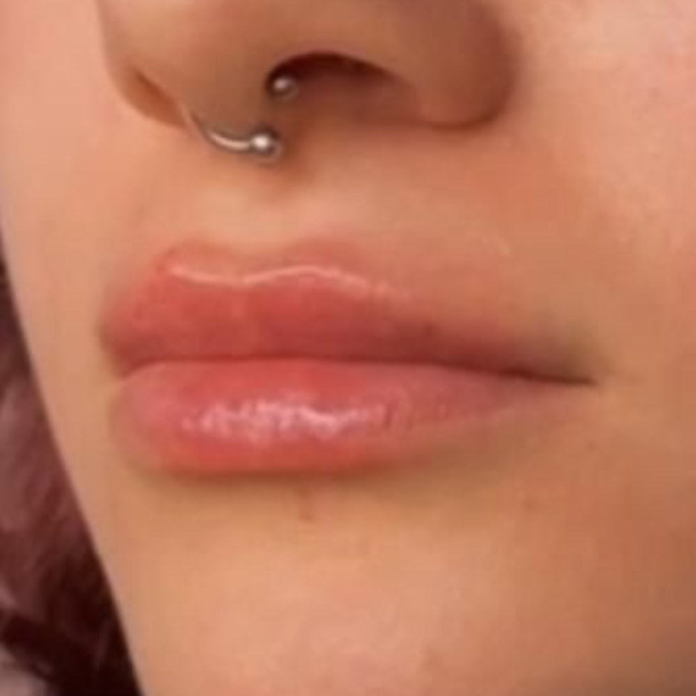 Sichtbar mehr Lippenvolumen nach nadelfreier Anwendung