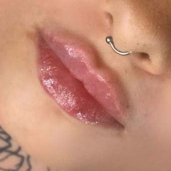 Aufgepolsterte Lippen nach Behandlung mit dem IRI® Filler-System