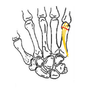 Intramed-Pin-System