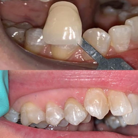 E-Max Restauration