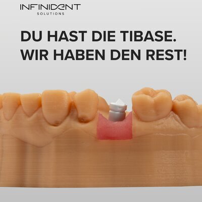 Implantatversorgung mit TiBase