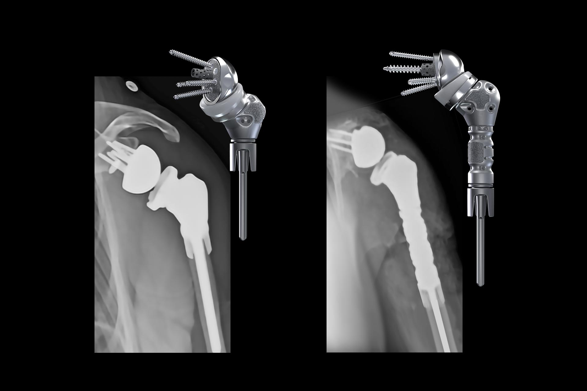 Equinoxe Humeral Reconstruction Prosthesis