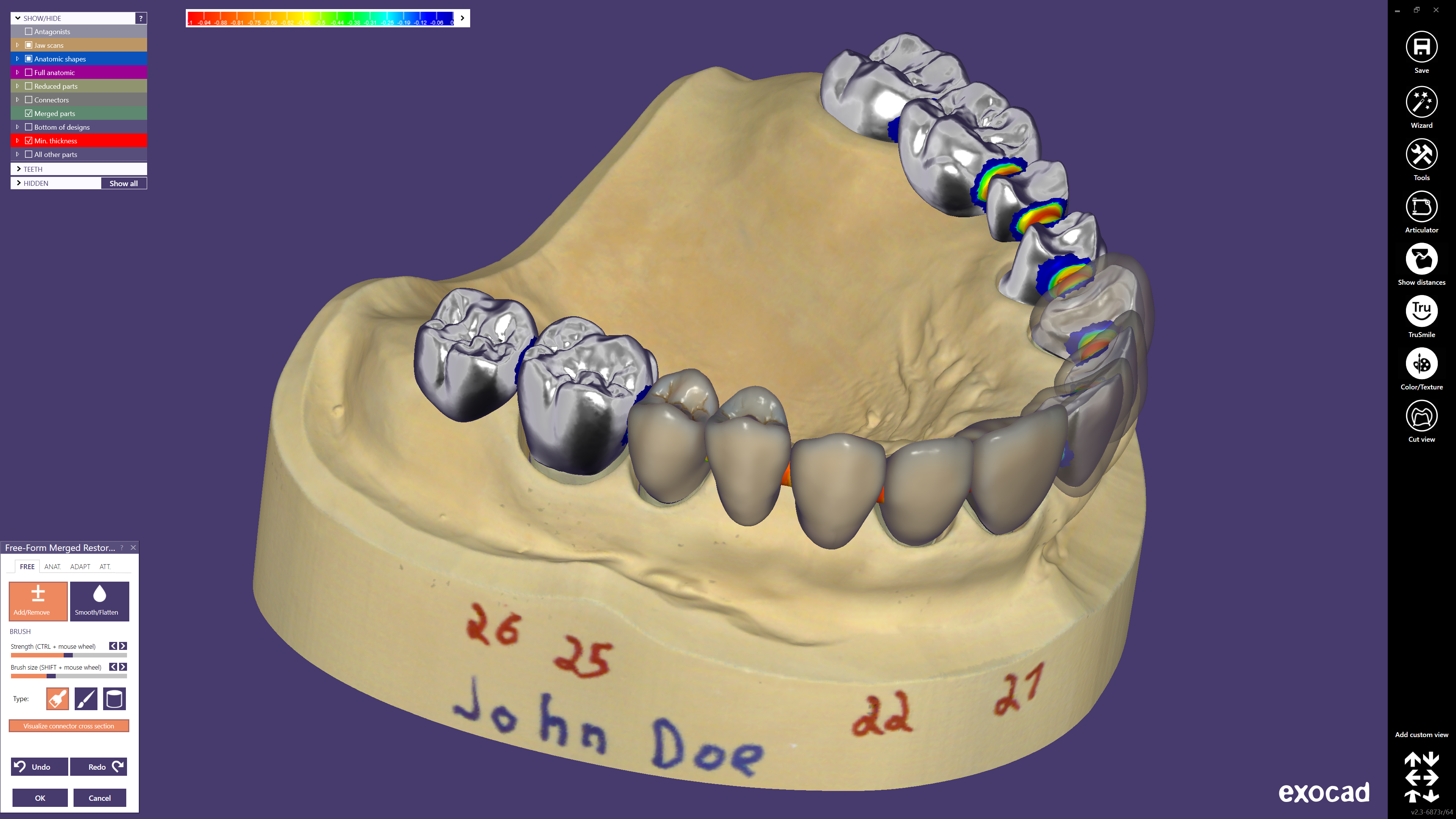 exocad DentalCAD Software-Oberfläche