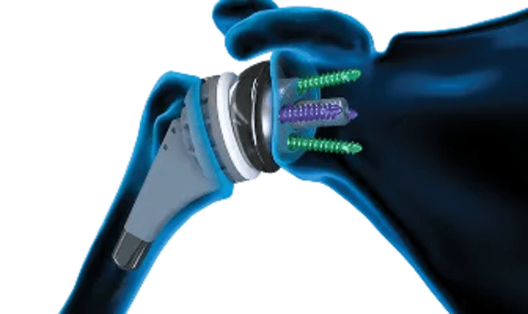 Arthroplasty