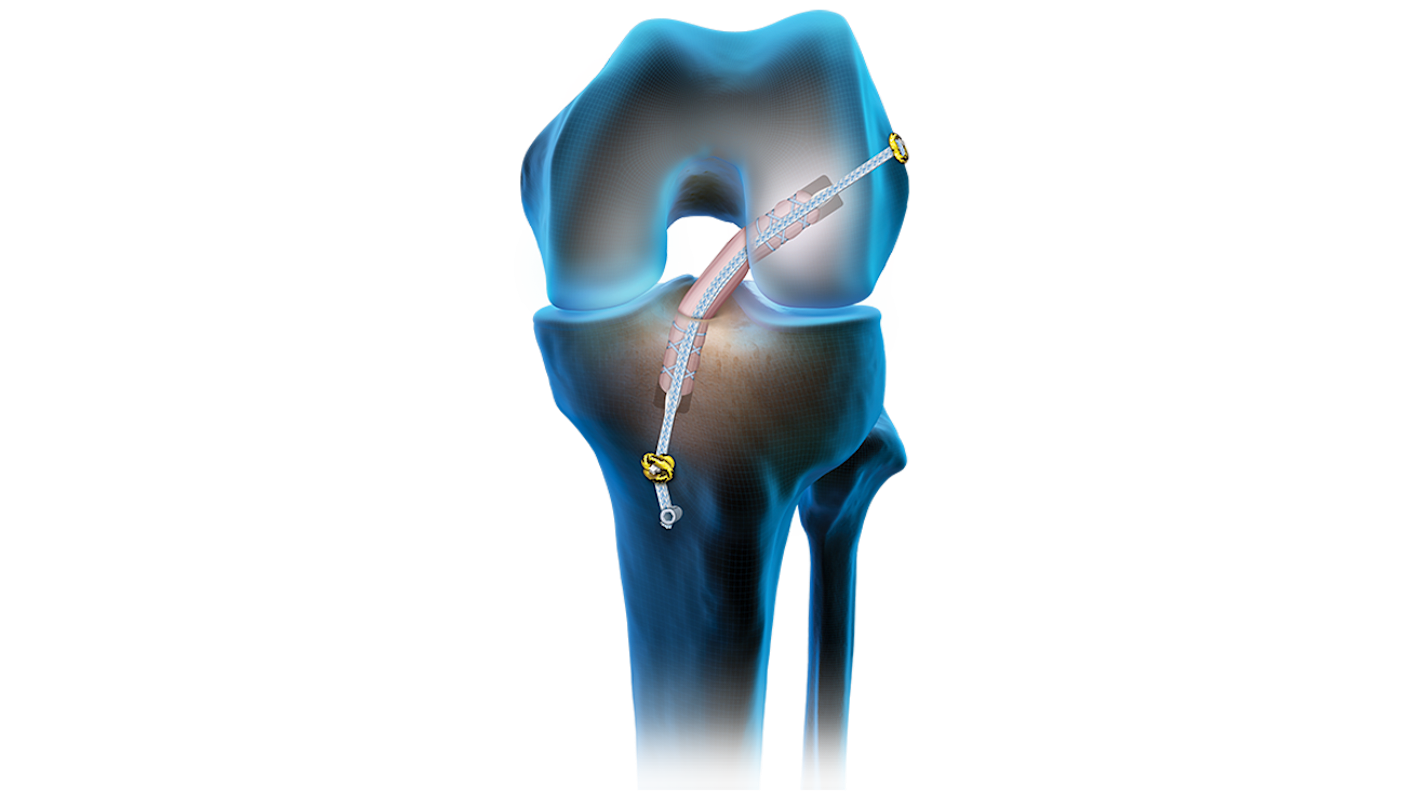 TightRope® SB Implants (all-suture Fixation)