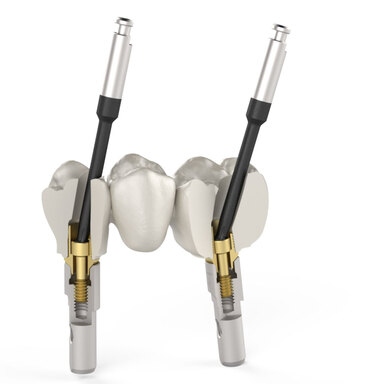 Direkte Implantatversorgung – Brücke