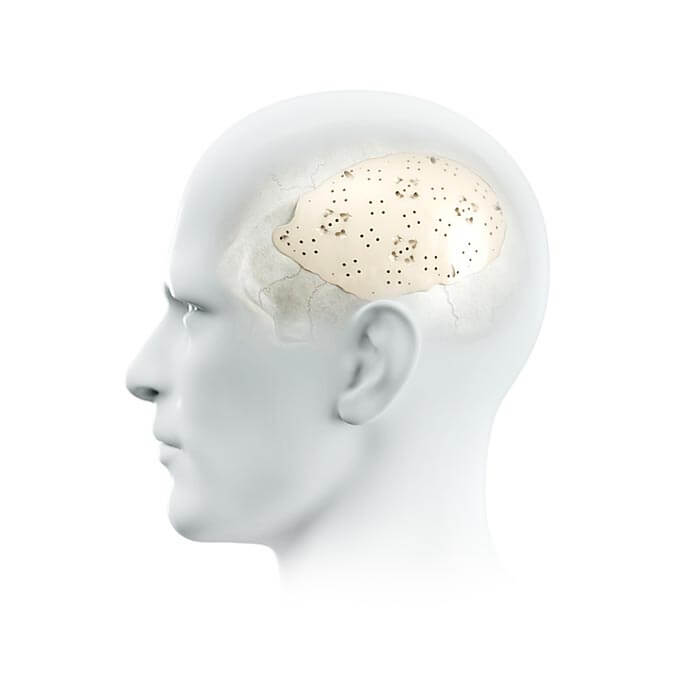 evoShape – patientenspezifisches Schädelimplantat
