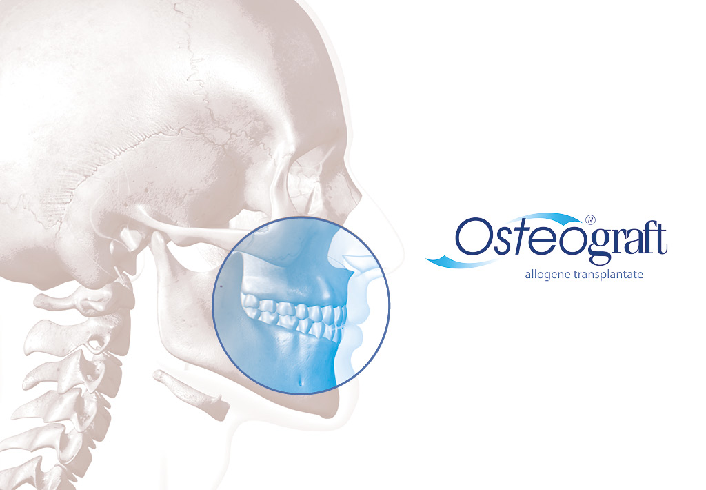 Osteograft