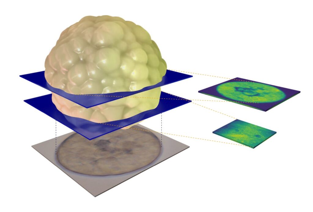 3D-Mapping durch ein MCF-7-Krebsorganoid