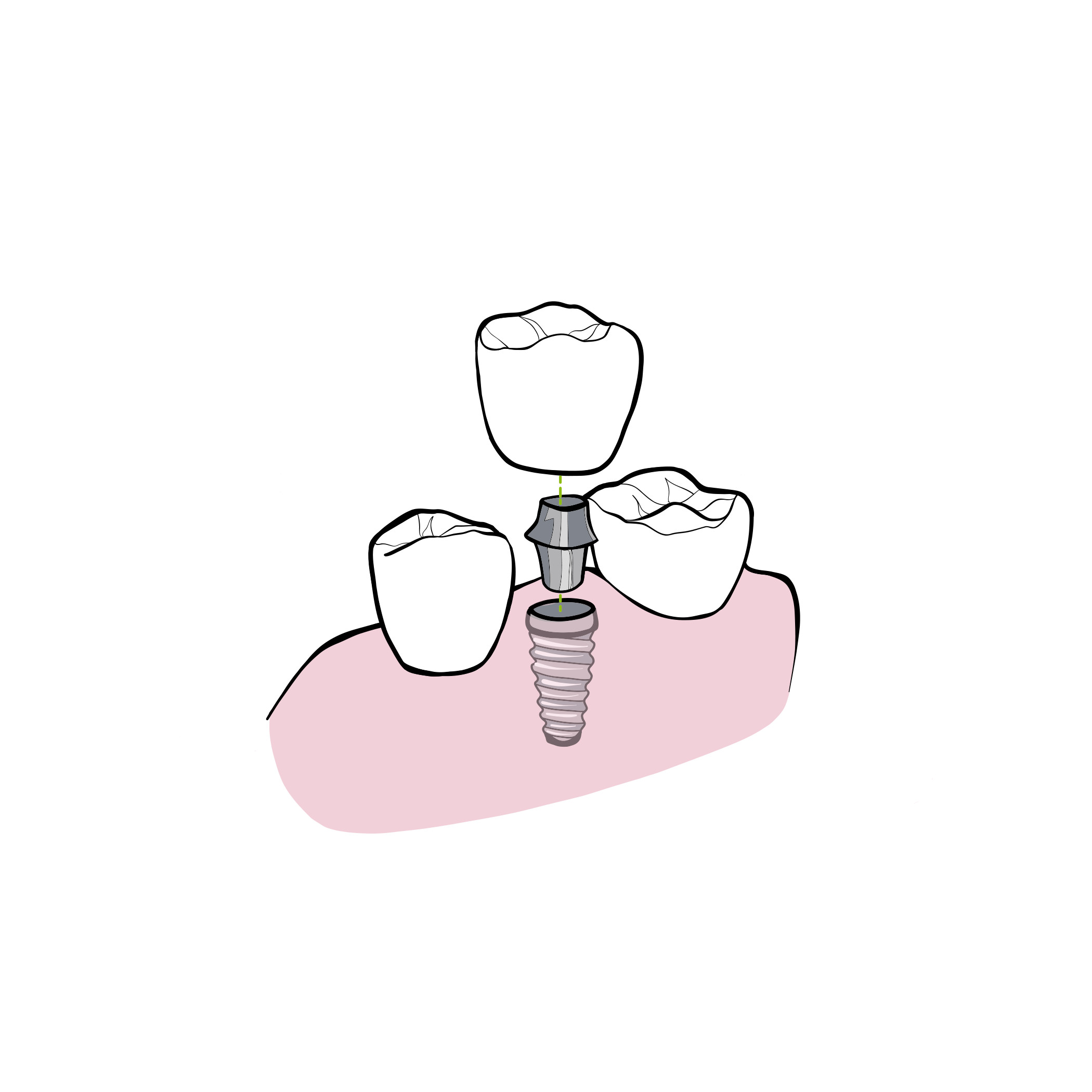 Implantatskrone
