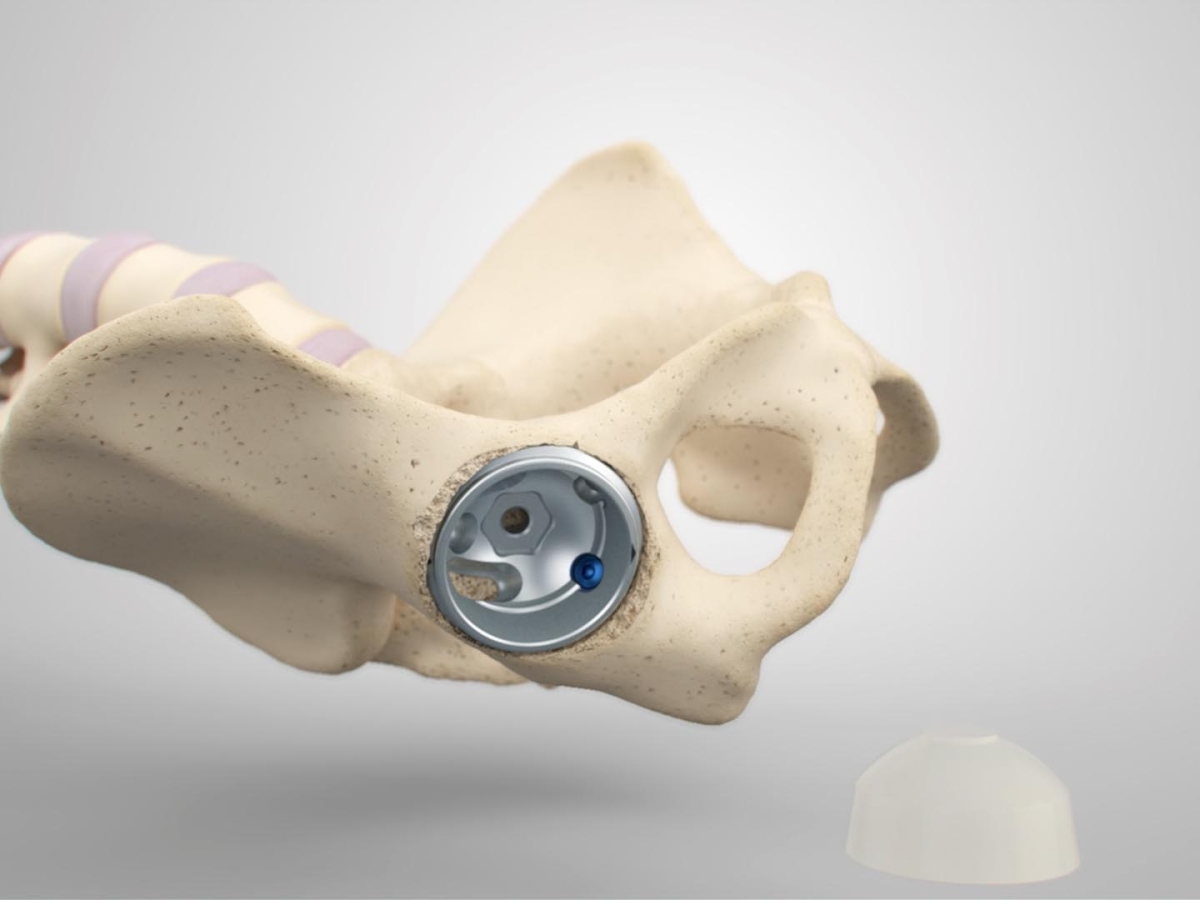 Aesculap Plasmafit® Revision
