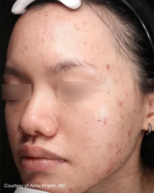 UltraClear Behandlungsergebnis: Aknenarben