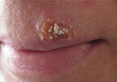 Herpes simplex