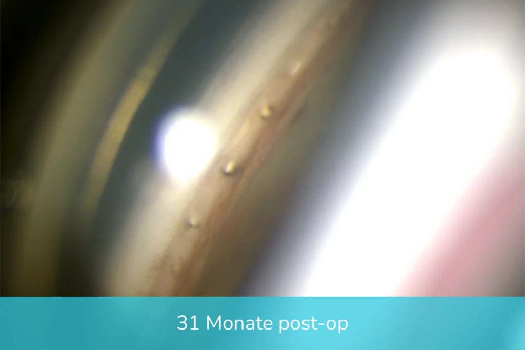 ELIOS Mikrokanäle, 31 Monate postoperativ