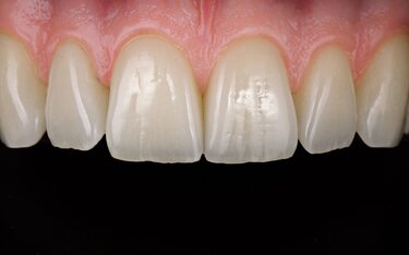 IPS e.max Press Multi