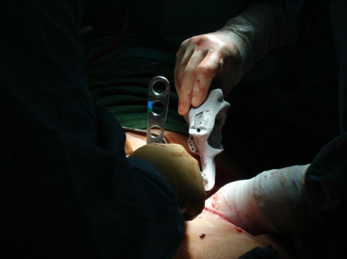 Custom-Made Implants