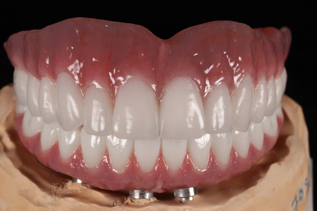 Veneer
