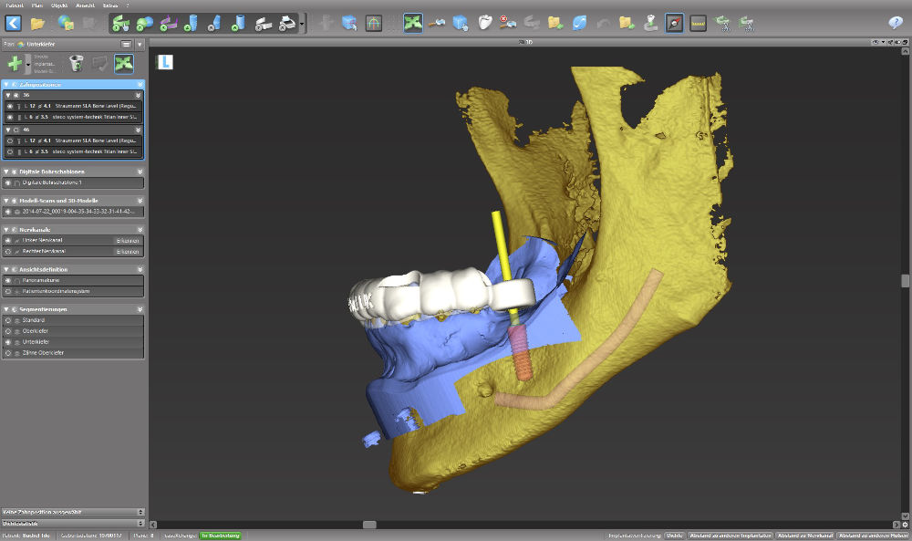 3D-Implantatplanung