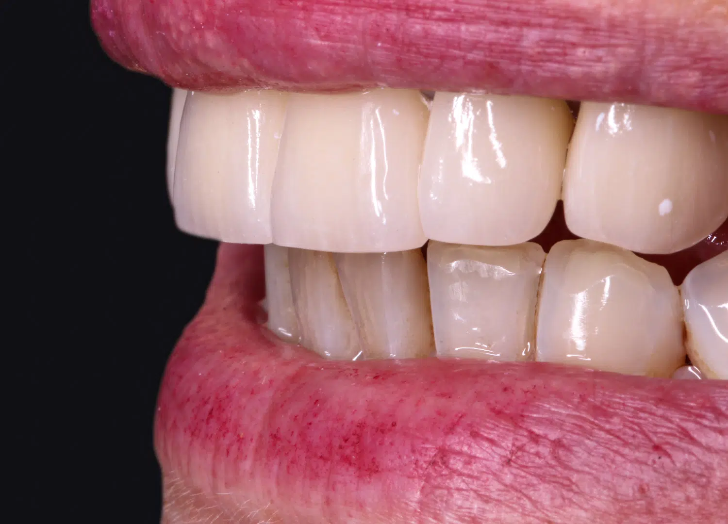 Model casting and veneering work