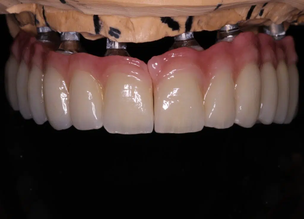 Dental technology production in Trassem