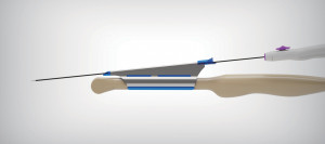 LiNA Versascope™ Sheath