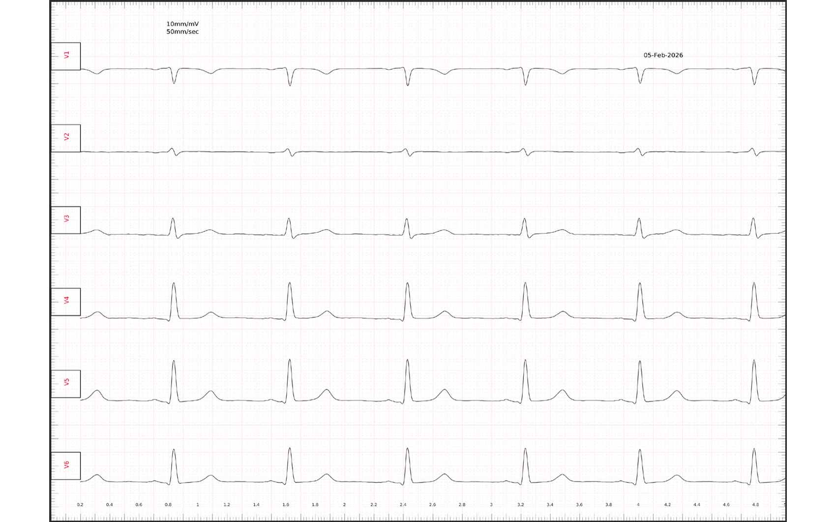 Konventionelles 12-Kanal-EKG