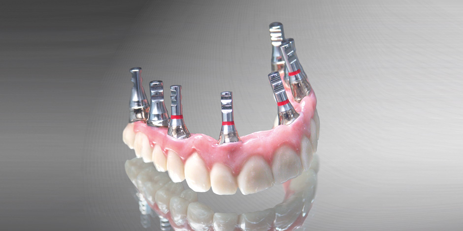Teleskopierende Implantatbrücke