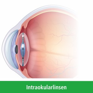 Intraokularlinsen