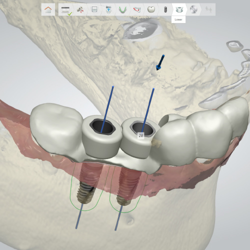 Guided Surgery