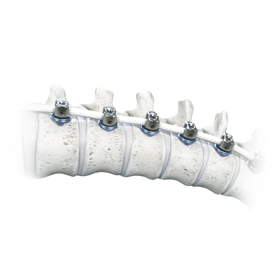The Tether Vertebral Body Tethering System