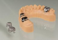 Sekundärkronen, verblockt, mit Ringretention & Klebeverbinder